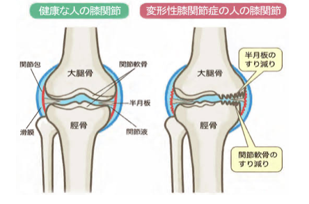 膝 痛 は 整形 外科 か 整骨 院 か