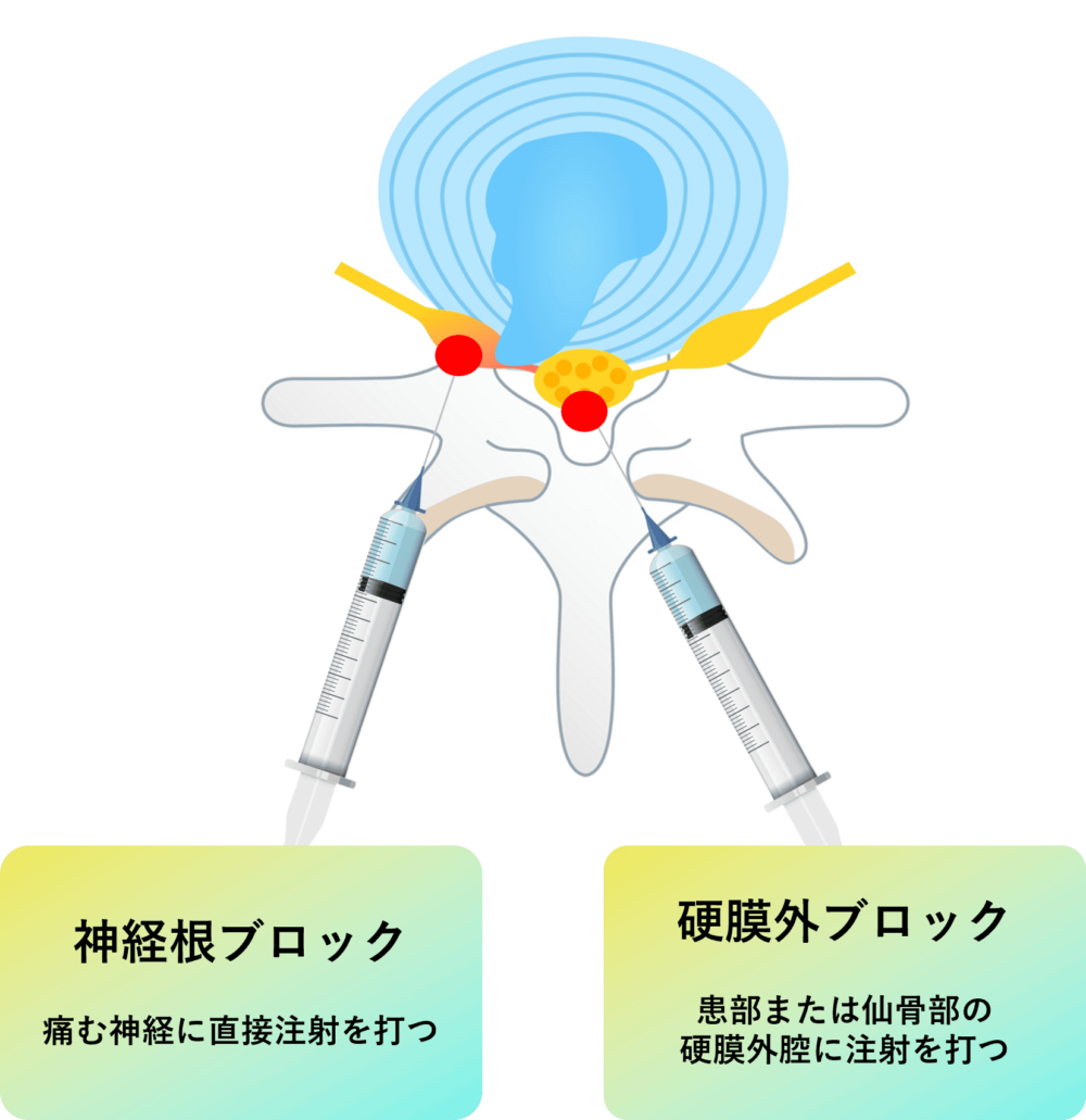 神経ブロック治療