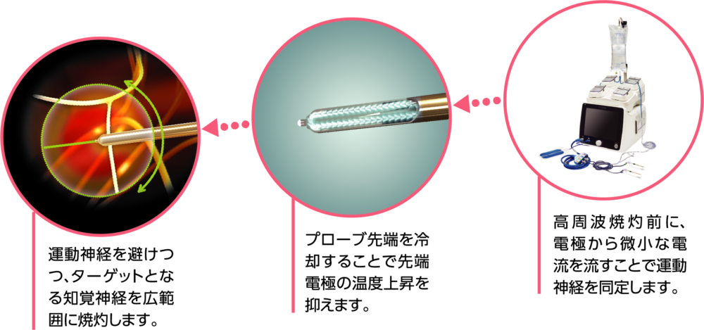 クーリーフは痛みを伝える「神経そのもの」を治療します